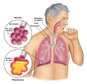 Legionella a klímaberendezéstől